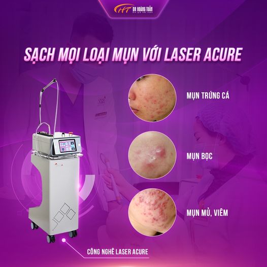 trị mụn bằng laser có hiệu quả không